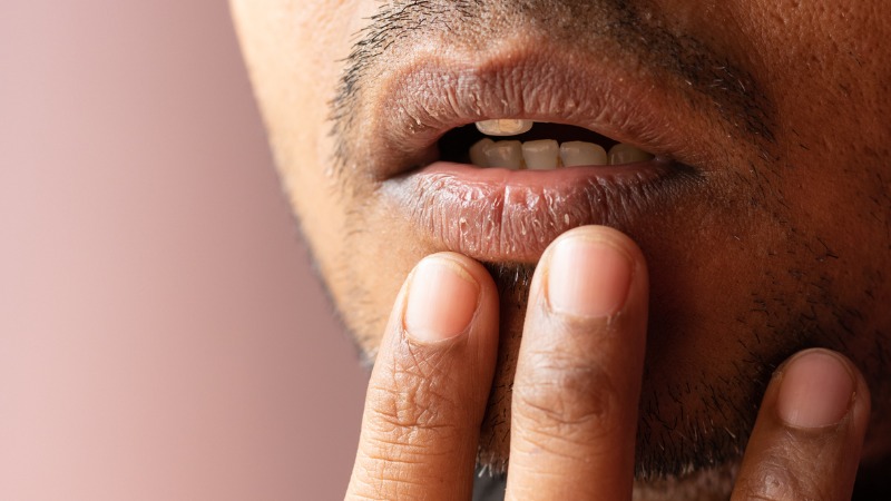 Homme aux lèvres sèches et gercées